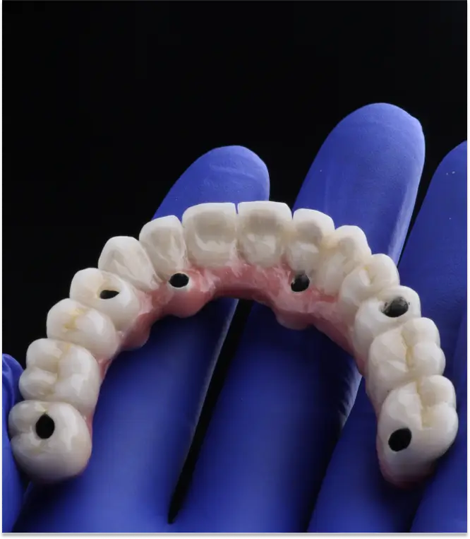 Advantages of All-on-X Implants