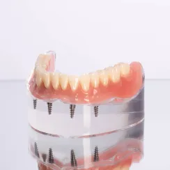 All on 4 Implants at Joobbani Dental Designs in Columbia, Maryland