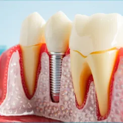 Dental Implants at Joobbani Dental Designs in Columbia, Maryland