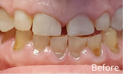 Full Mouth Rehab Before