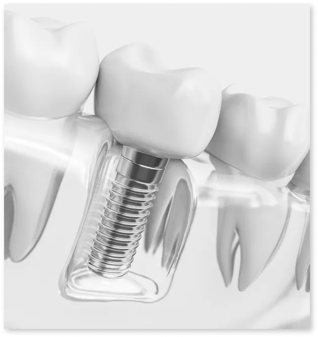 Invisalign Treatment