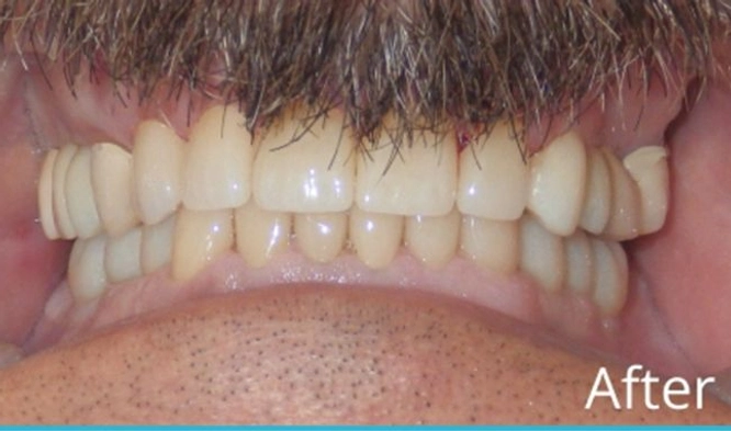 After Dental Implants