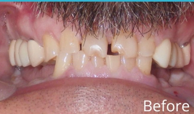 Before Dental Implants
