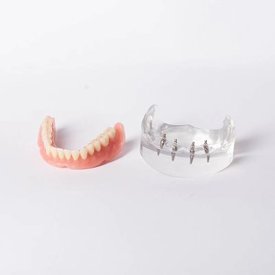 Implant Overdentures in Columbia, MD