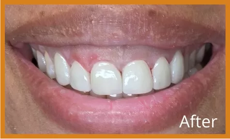 Veneers After